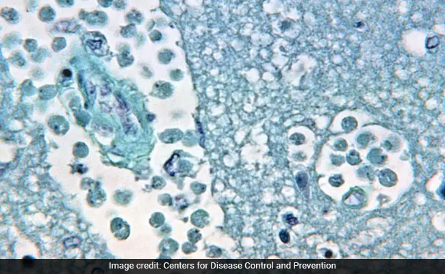 A man in USA dies of Brain eating amoeba.
