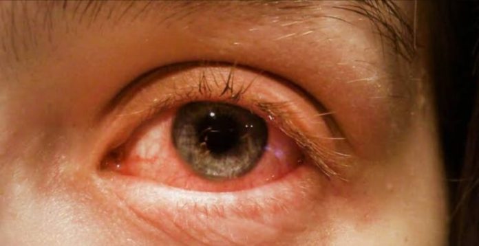 Conjunctivitis Cases on the Rise What is this Infection